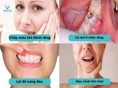 viêm nha chu uống thuốc gì dấu hiệu viêm nha chu