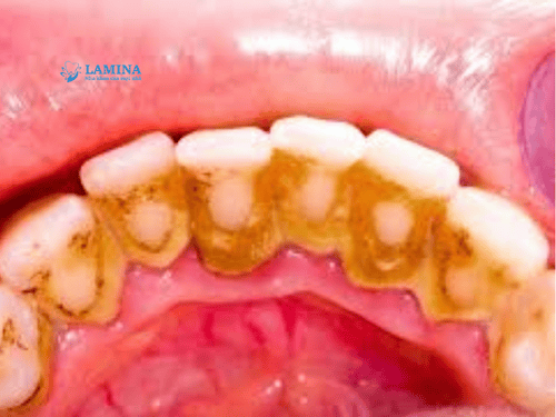 Lấy cao răng có lâu không? Giải đáp chi tiết từ A–Z cho người lần đầu đi nha khoa