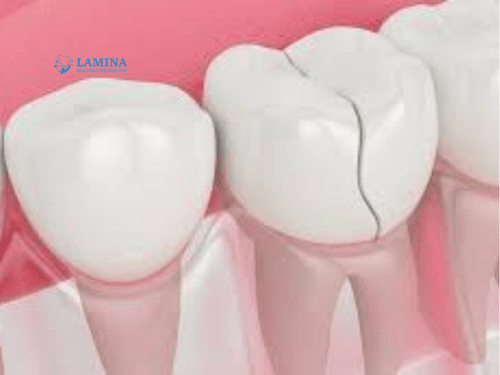 Răng bị nứt: Nguyên nhân, mức độ nguy hiểm