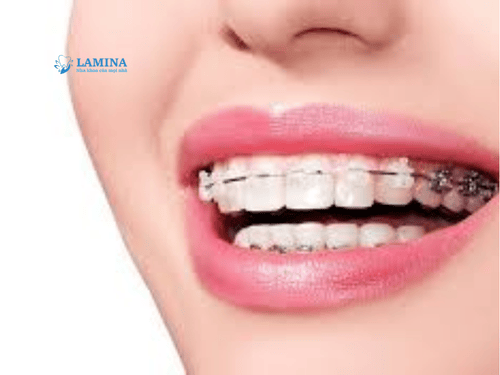 Niềng răng có được vĩnh viễn không? Sự thật ai cũng nên biết trước khi chỉnh nha