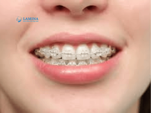 Niềng răng có được vĩnh viễn không? Sự thật ai cũng nên biết trước khi chỉnh nha