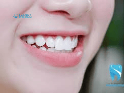 Răng thỏ hô là gì? Răng thỏ có bị hô không và cách khắc phục hiệu quả