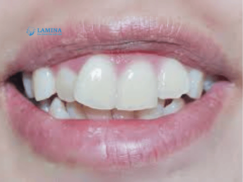 Răng thỏ hô là gì? Răng thỏ có bị hô không và cách khắc phục hiệu quả