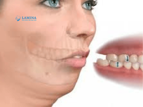 Răng thỏ hô là gì? Răng thỏ có bị hô không và cách khắc phục hiệu quả