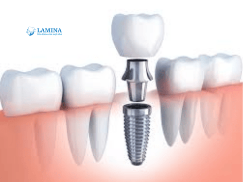 Trồng răng Implant là gì? Có nên trồng răng Implant không?