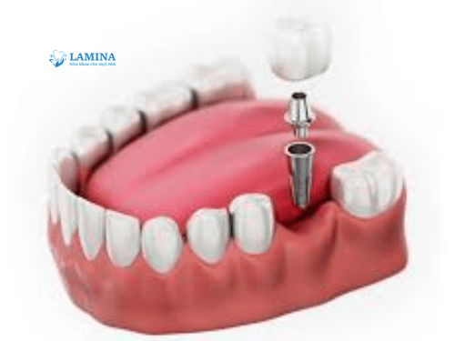 Trồng răng Implant là gì? Có nên trồng răng Implant không?