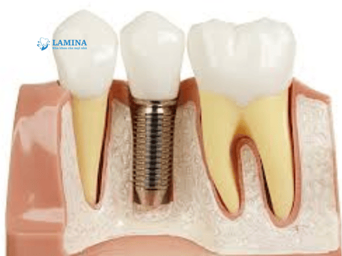 Trồng răng Implant là gì? Có nên trồng răng Implant không?