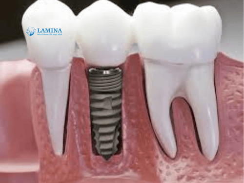 Trồng răng Implant là gì? Có nên trồng răng Implant không?