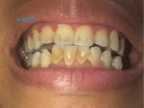 Răng Bị Ố Vàng