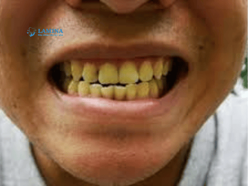 Răng Bị Ố Vàng