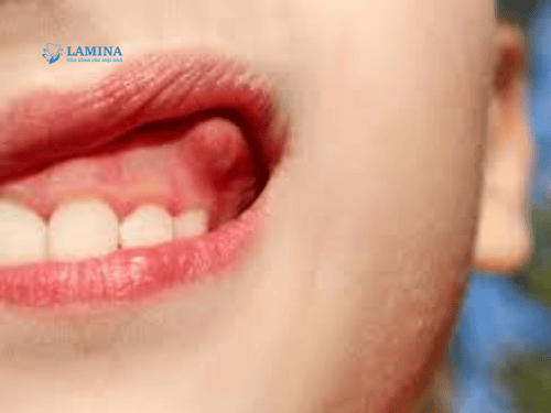 Dấu hiệu nhận biết áp xe