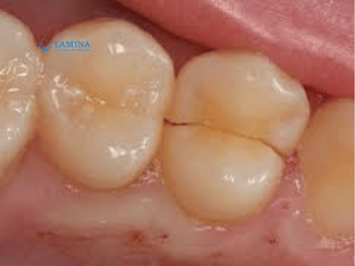 Răng bị nứt: Nguyên nhân, mức độ nguy hiểm