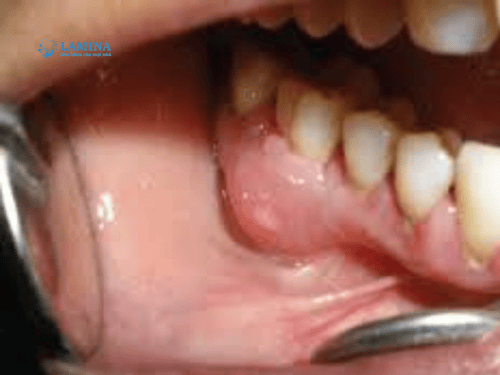  ảnh minh họa áp xe răng