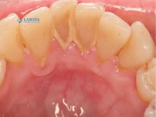 Lấy cao răng có lâu không? Giải đáp chi tiết từ A–Z cho người lần đầu đi nha khoa