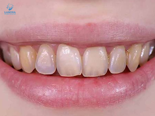 hình ảnh men răng yếu