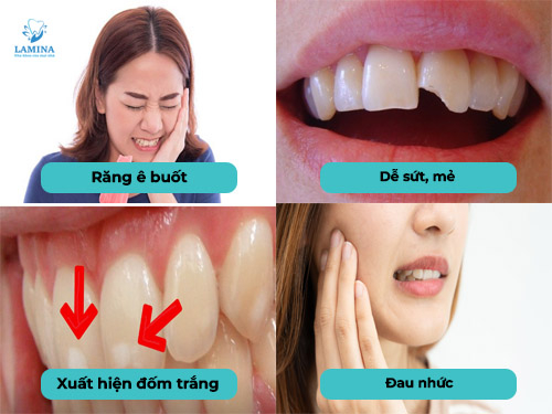 men răng yếu: dấu hiệu