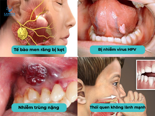 u men răng: nguyên nhân