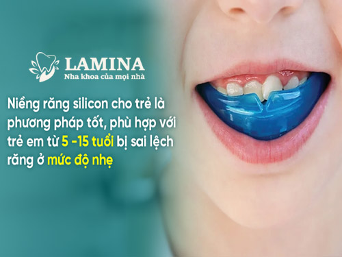 niềng răng silicon cho bé độ tuổi phù hợp