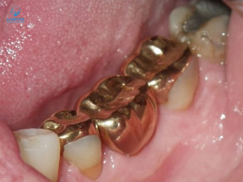 răng bị đen: chụp mão