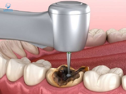 răng bị đen: điều trị sâu