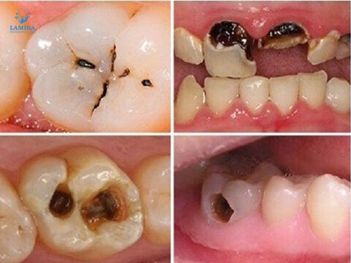 răng bị đen: sâu răng
