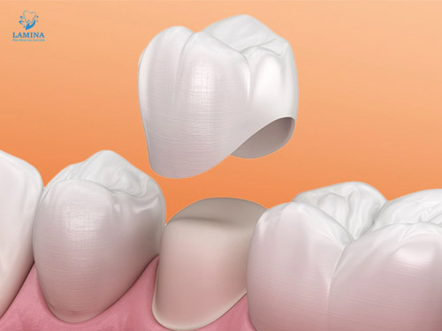 răng bị đen: mão răng