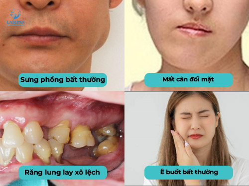 u men răng: dấu hiệu