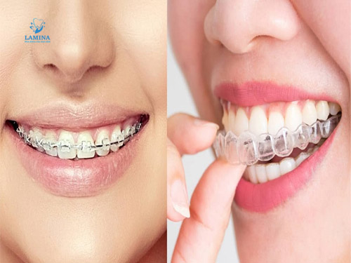 niềng răng tại nha khoa lamina: các loại niềng răng