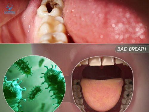 sâu răng có gây hôi miệng không