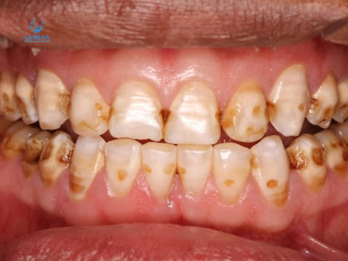 sâu răng có gây hôi miệng không: do axit