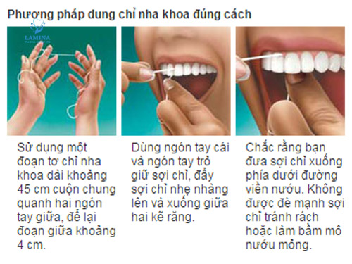 sâu răng có gây hôi miệng không: dùng chỉ nha khoa