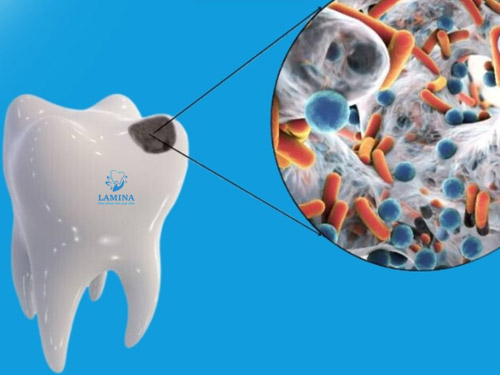 sâu răng có gây hôi miệng không: vi khuẩn trong răng