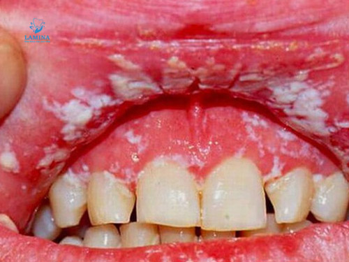 sâu răng có gây hôi miệng không: nguyên nhân viêm