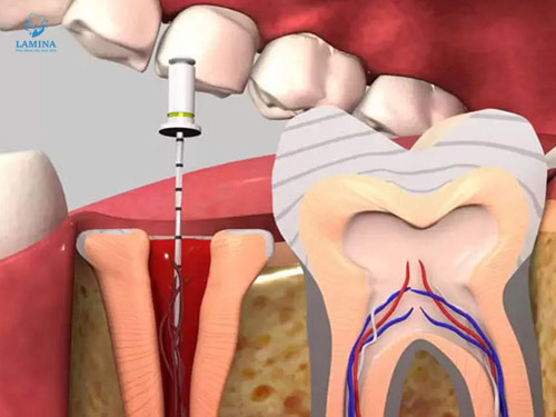 sâu răng hàm có lỗ: chữa tuỷ