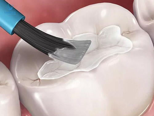 sâu răng hàm có lỗ: trám răng