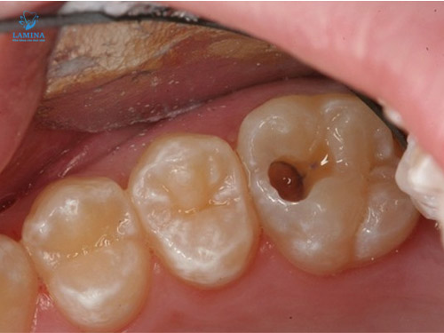 sâu răng hàm có lỗ