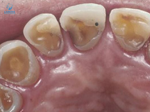 sâu răng hàm có lỗ: mức độ 2