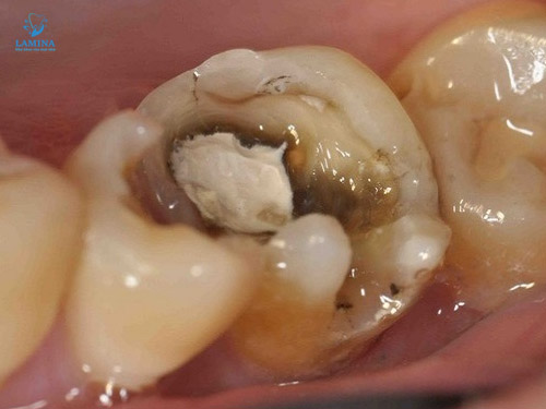 sâu răng hàm có lỗ: mức độ 3