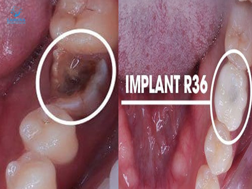 sâu răng hàm có lỗ: nhổ và phục hình