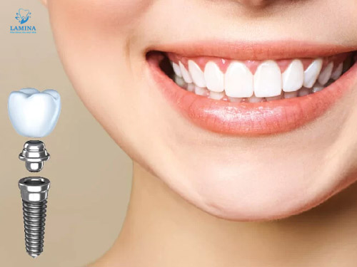 cấy ghép implant ở đâu