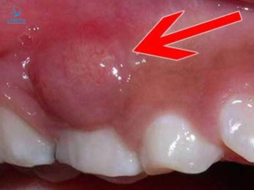 lấy tuỷ răng ở Đông Anh: áp xe