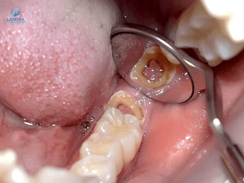 lấy tuỷ răng ở Đông Anh: nguy cơ mất răng