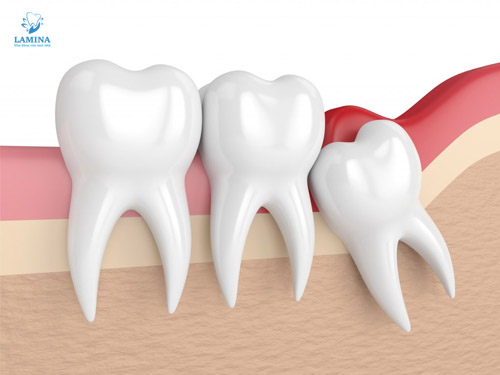 nhổ răng không tại đông anh: mọc lệch mức độ 1, 2