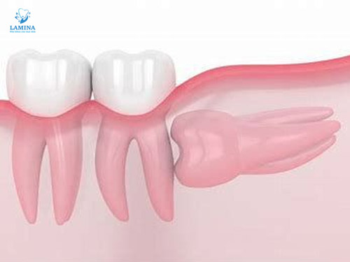 nhổ răng không tại đông anh: mọc ngầm