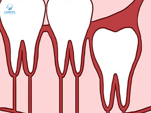 nhổ răng không tại đông anh: mọc thẳng