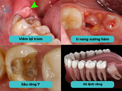 nhổ răng không tại đông anh: Tại sao phải nhổ