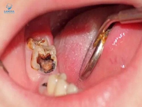 răng sâu vào tuỷ có cứu được không