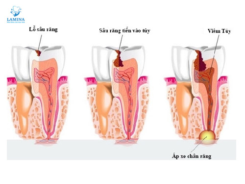 răng sâu vào tuỷ có cứu được không: các giai đoạn