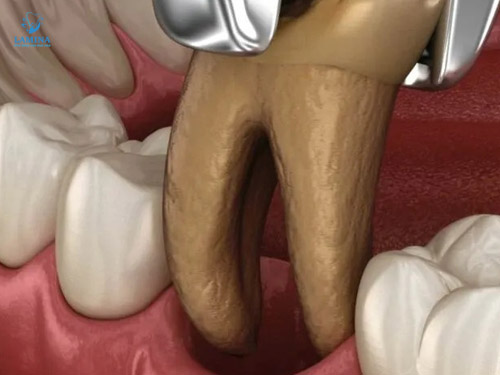 răng sâu vào tuỷ có cứu được không: nhổ