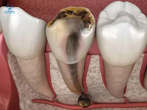 dấu hiệu viêm tuỷ răng cấp